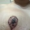 Necrosi capezzoli post mastroplastica riduttiva