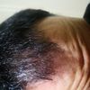 Possibile alopecia??