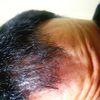 Possibile alopecia??
