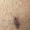 Macchia scura cicatrice post asportazione neo