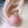 Cheloide orecchio - 16924