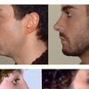 Taglio muscolo naso labiale - 17011