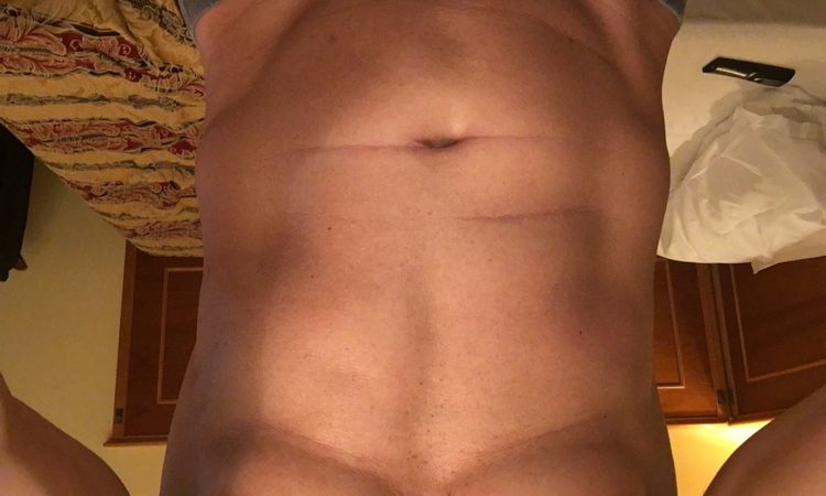 Lipo vaser - 17039