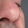 Rinoplastica: naso grosso? - 17083