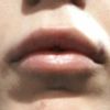 Filler labbra con effetto canotto - 17085