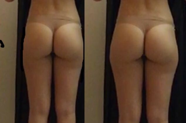Intralipoterapia in che casi funziona meglio? - 17098