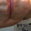 Filler labbra a 60 anni