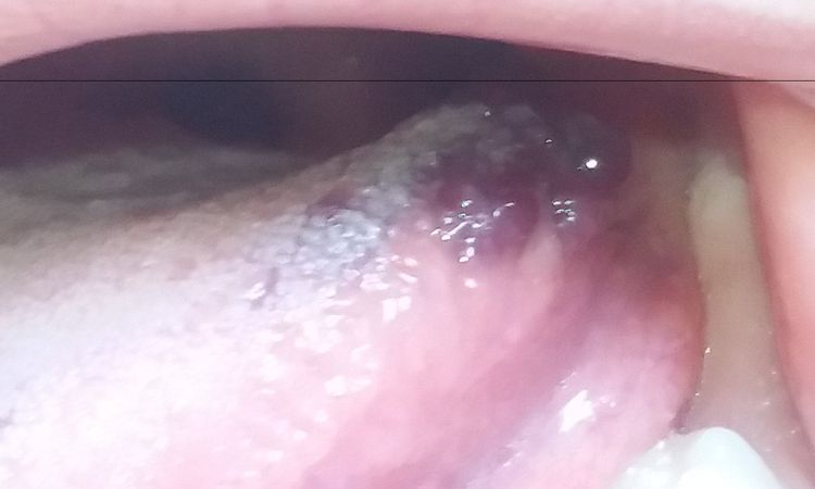 Angioma lingua - 17174