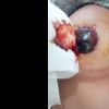 Sangue dal capezzolo post intervento