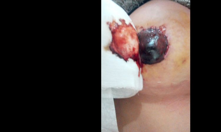 Sangue dal capezzolo post intervento - 17225