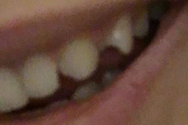 Apparecchio per raddrizzare un solo dente?