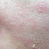 Risultati laser CO2 lievi cicatrici da acne non visibili?