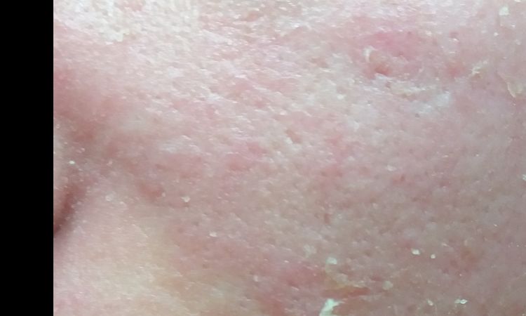 Risultati laser CO2 lievi cicatrici da acne non visibili? - 17255