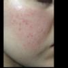 Idrochinone per macchie post acne? - 17279