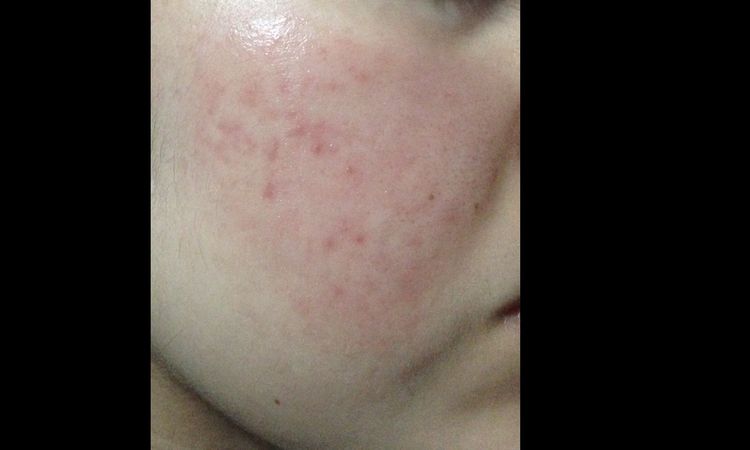 Idrochinone per macchie post acne? - 17279