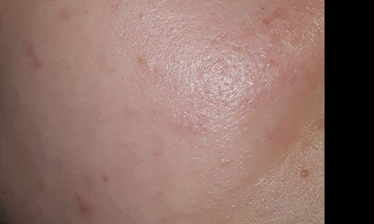 Trattamento adeguato per Rosacea e pori dilatati o cicatrici? - 17281