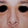 Affossamento laterale naso dopo rinosettoplastica - 17288