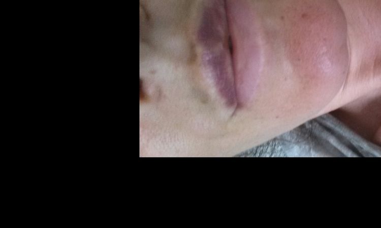 Filler labbra sono orribile - 17349