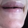 Prolasso labbra dopo acido ialuronico - 17350