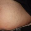 Per le smagliature bianche  funziona la carbossiterapia?