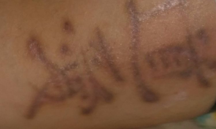 rimozione tatuaggio, consiglio situazione dopo 5 sedute - 17401