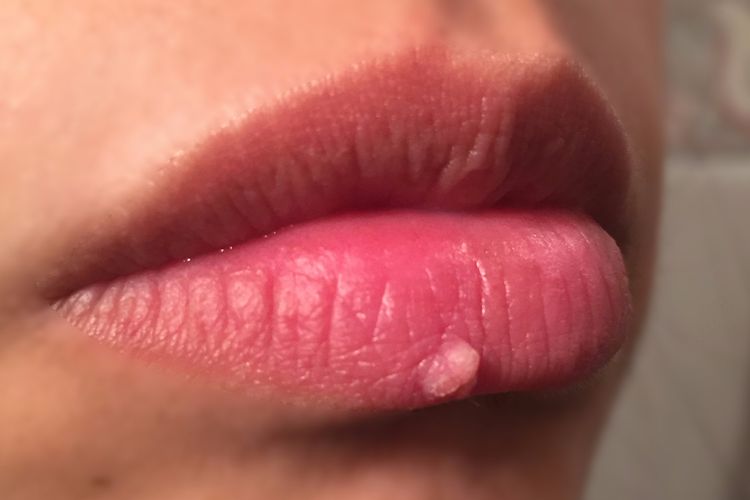Rimozione verruca su labbro inferiore. Laser? Estate o Autunno?