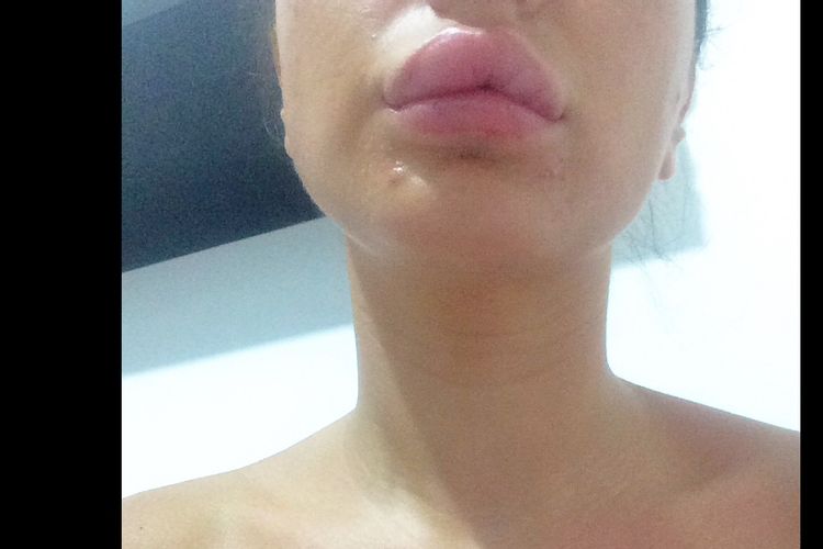 Reazione allergica o gonfiore post filler per le labbra?! Aiutatemi per favore