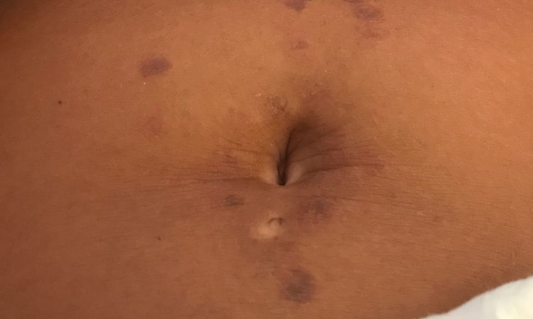 Bruciatura post laser - 17458