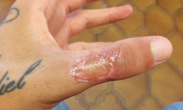 Che crema usare per la cicatrizzazione post operazione e punti? - 17531