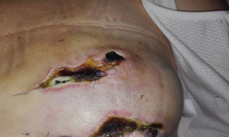 Mastectomia con ricostruzione immediata? - 17547