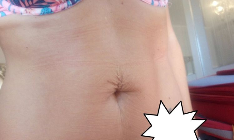 Lipofilling Periombelicale. Round Block? - 17578