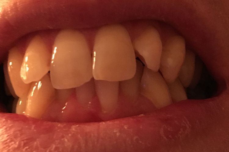 Raddrizzare Dente?
