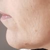 Mesobotox