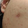 Residuo post cheratosi seborroica?