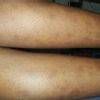 Cicatrici gambe per eczema? - 17853