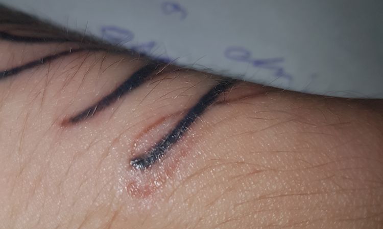 Probabile cicatrice post seduta picolaser? - 18025