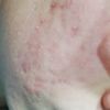 Peeling, needling o laser