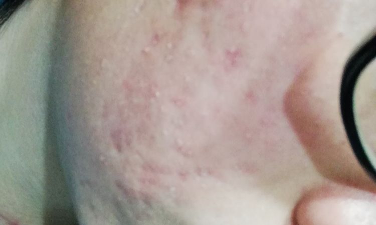 Peeling, needling o laser - 18219