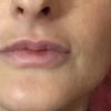 Filler labbra labbra turgide dopo cinque giorni - 18816