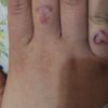 Rimozione tatuaggio con pico laser
