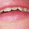 Puntini bianco/gialli sul labbro superiore della bocca - 19036