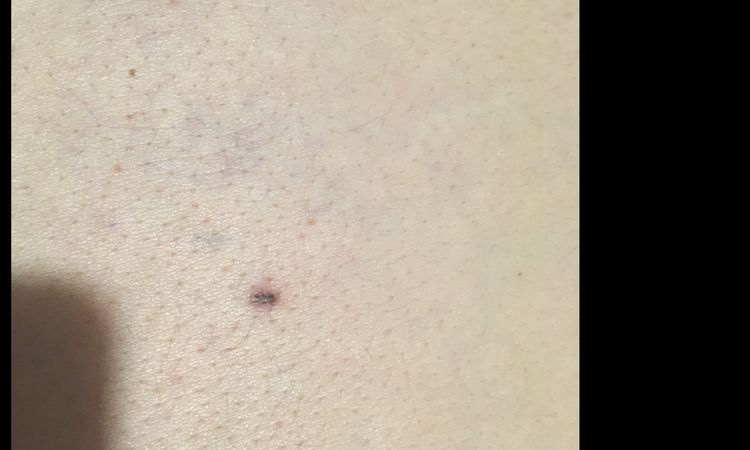 Cicatrice dopo laser fibroma pendulo - 19200
