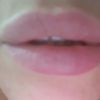Filler labbra:labbra asimmetriche grumi dolore - 19294