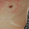 Si può effettivamente trattare di una cheratosi?