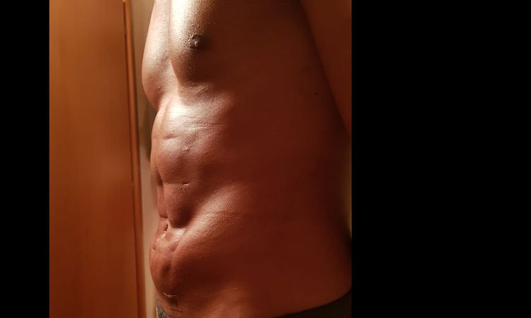 AIUTOO!! chiedo gentilmente consiglio post operazione vaser lipo addome - 19650