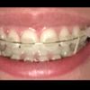 Elastici apparecchio ortodontico - 19670
