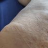 Sieroma post liposuzione?