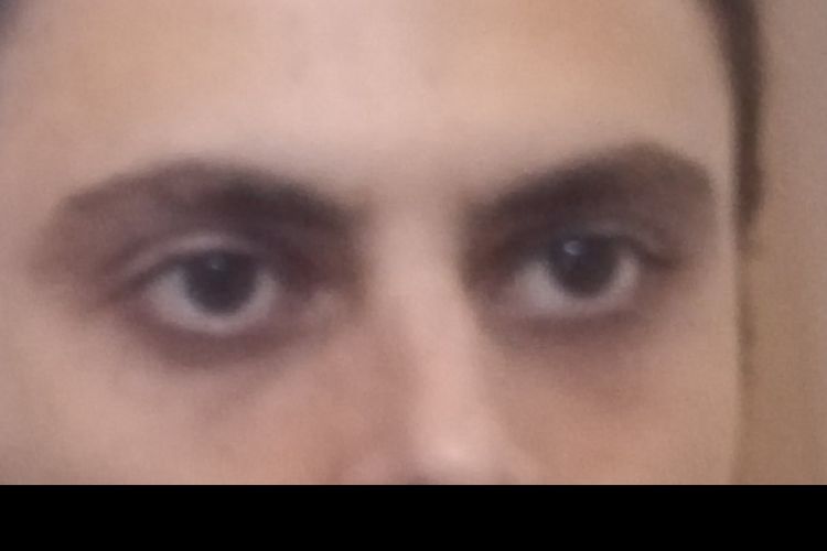 Scleral show e Almond Eye Surgery Guidaestetica.it