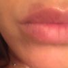 Macchia/cicatrice rosso scuro sul labbro post trattamento laser alessandrite - 19841