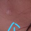 Micro-needling con Dermaroller su cicatrice da nevo sul petto